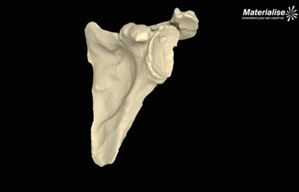 Mathys引進Materialise的3D肩關節手術規劃軟件 Mathys引進Materialise的3D肩關節手術規劃軟件
