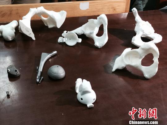 3D打印金屬假體在江西首次植入人體(圖)