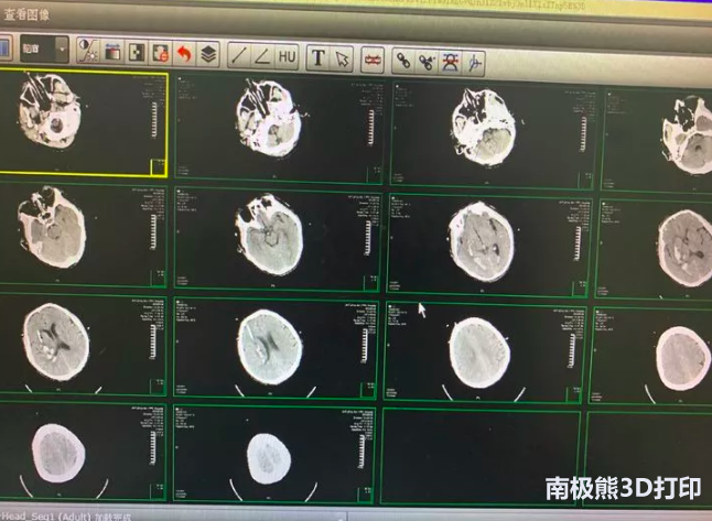 3D-slicer輔助3D打印導(dǎo)板技術(shù)及其臨床運(yùn)用 3D-slicer輔助3D打印導(dǎo)板技術(shù)及其臨床運(yùn)用