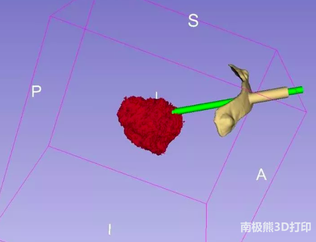 3D-slicer輔助3D打印導(dǎo)板技術(shù)及其臨床運(yùn)用 3D-slicer輔助3D打印導(dǎo)板技術(shù)及其臨床運(yùn)用