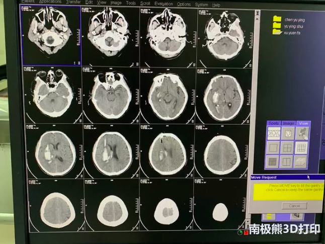 3D-slicer輔助3D打印導(dǎo)板技術(shù)及其臨床運(yùn)用 3D-slicer輔助3D打印導(dǎo)板技術(shù)及其臨床運(yùn)用