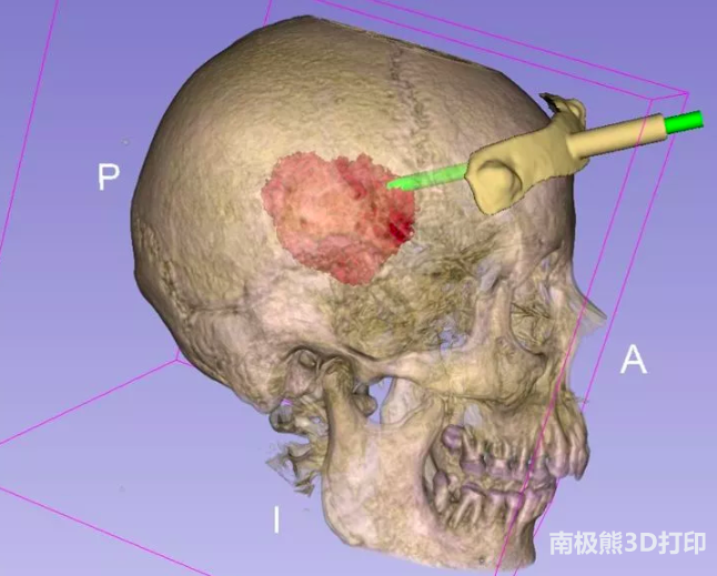 3D-slicer輔助3D打印導(dǎo)板技術(shù)及其臨床運(yùn)用 3D-slicer輔助3D打印導(dǎo)板技術(shù)及其臨床運(yùn)用