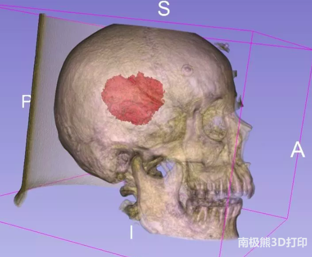 3D-slicer輔助3D打印導(dǎo)板技術(shù)及其臨床運(yùn)用 3D-slicer輔助3D打印導(dǎo)板技術(shù)及其臨床運(yùn)用